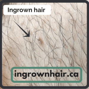 What causes ingrown hairs- ingrownhair.ca
