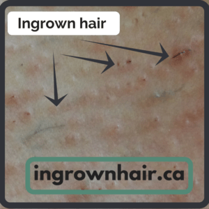 https://ingrownhair.ca/causes-ingrown-hairs/