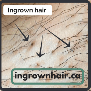 Ingrown hairs can be a pain and look terrible