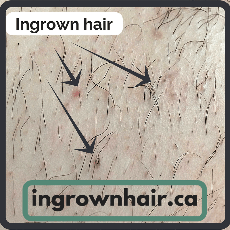 What does an ingrown hair look like?