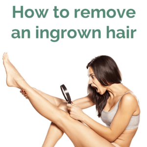 How to remove an ingrown hair