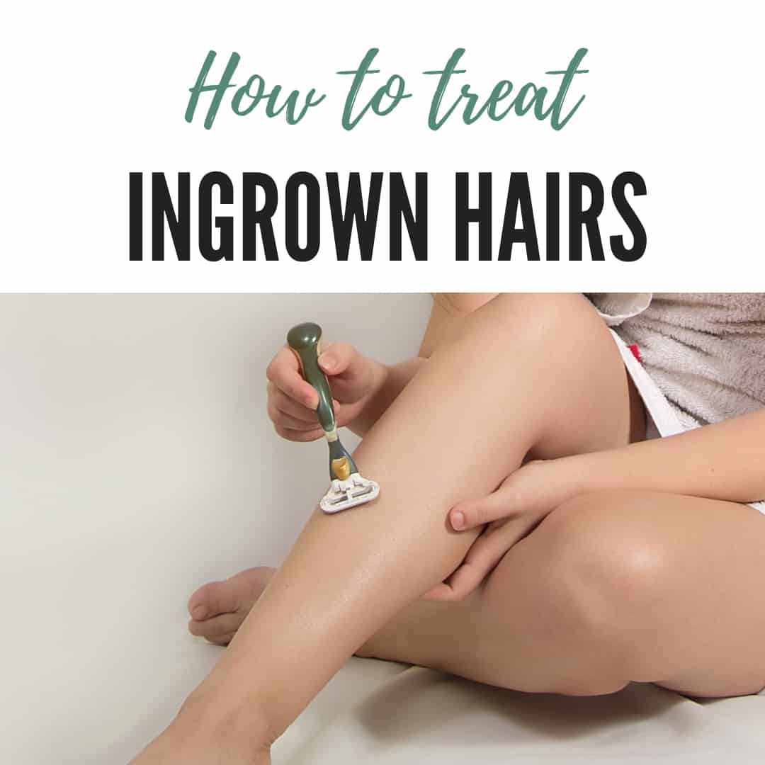 Learn how to treat ingrown hair.