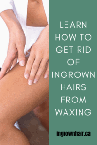 How to get rid of ingrown hairs from waxing