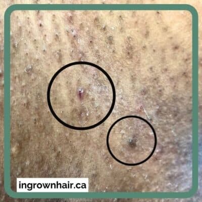 13 How to treat ingrown hairs with tea tree oil Learn what causes ingrown hairs, how to treat razor bumps and how to prevent bikini rash.