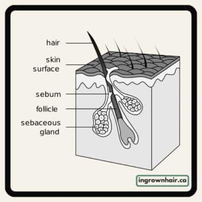Anatomy of an ingrown hair
