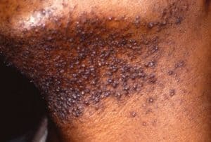 Picture of Pseudofolliculitis Barbae (PFB) from Madigan Army Medical Center Dermatology and SAUSHEC Dermatology teaching file