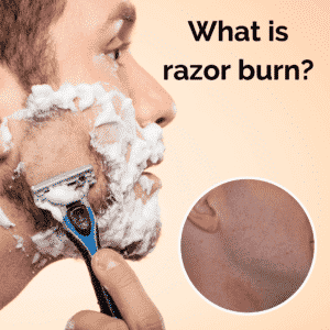 What is razor burn and how can you treat it?