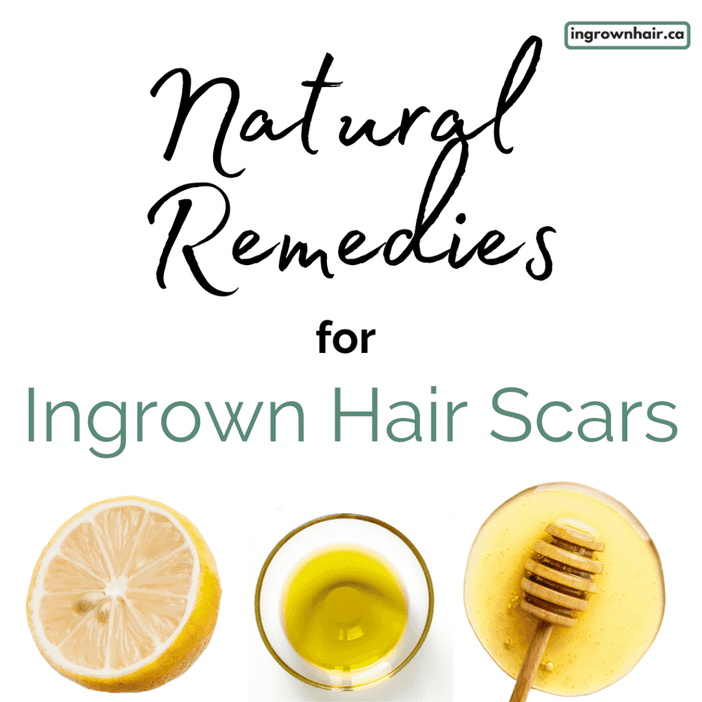 the-easy-way-to-get-rid-of-and-reduce-scars-from-ingrown-hair