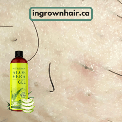 Try home remedies for ingrown hairs