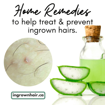Home remedies to treat and prevent ingrown hairs