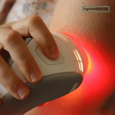 Home laser treatments can prevent ingrown hairs